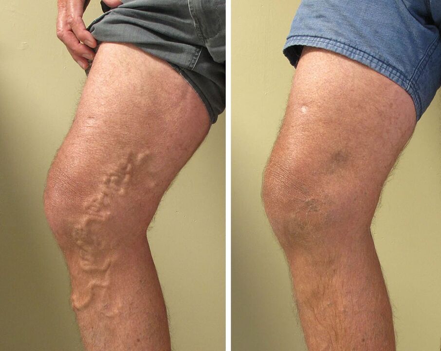 Experience with Gel Vasaxal
