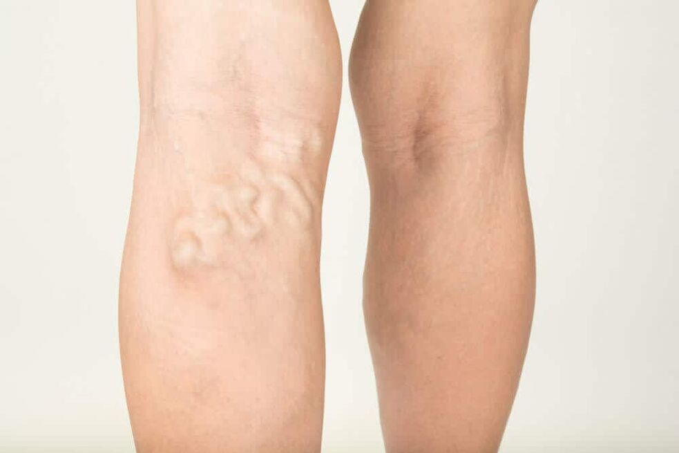 Manifestations of varicose veins
