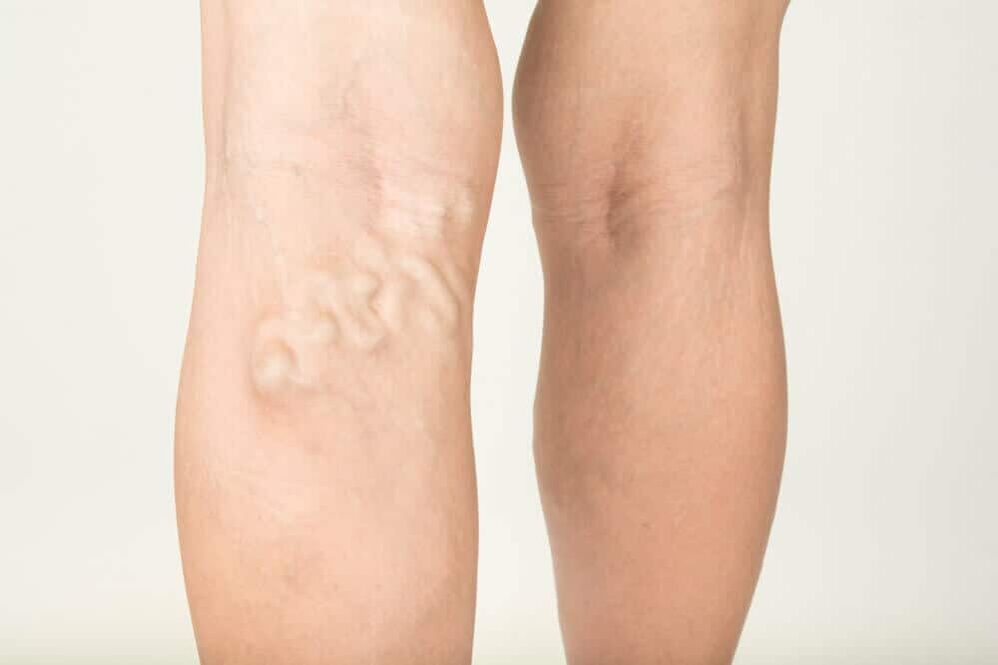 Varicocele manifestations