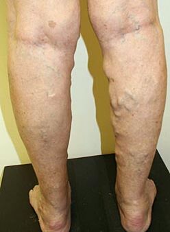 Veins on the legs