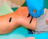 Varicocele water ech
