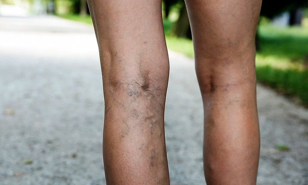Swelling veins on the legs