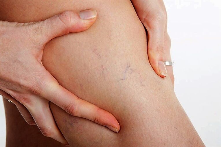 Vein net on the legs