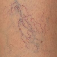 Varicocele manifestations