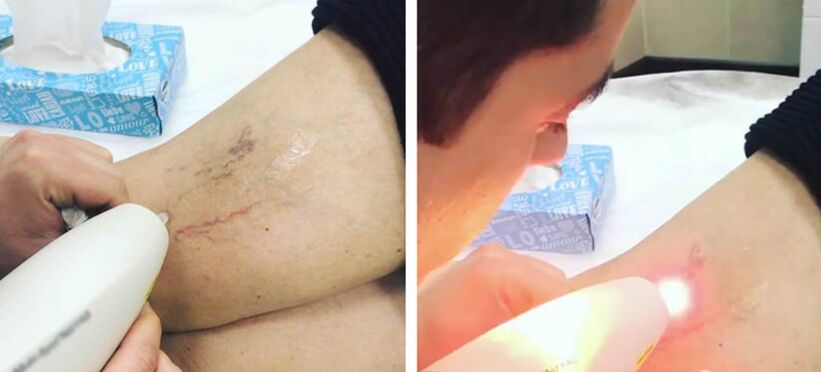 Laser therapy