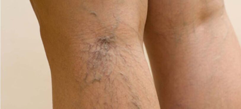 Veins on the legs