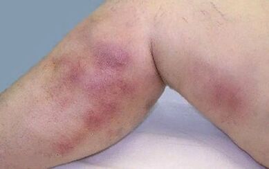 How to show varicose veins