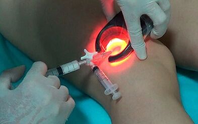 Sclerotherapy is a way to treat varicose veins in the legs