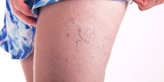 Methods for treating varicose veins