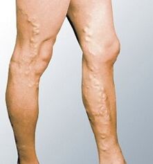 Varicocele manifestations
