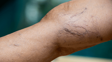 Prevent varicose veins