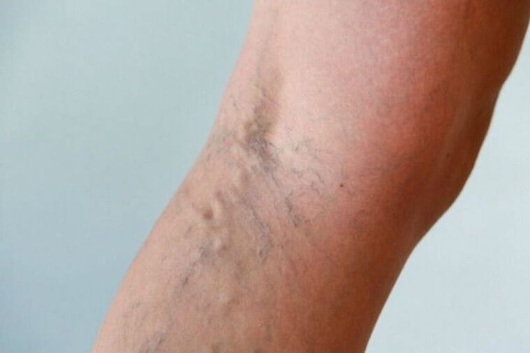 Treatment of varicose veins in women