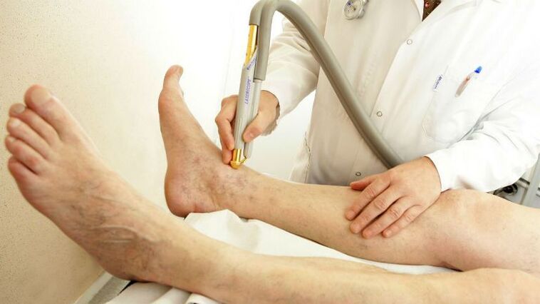 Varicose veins on inner leg