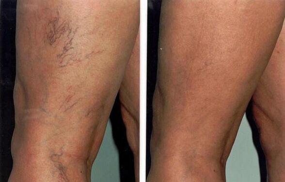 Varicose vein treatment before and after photos
