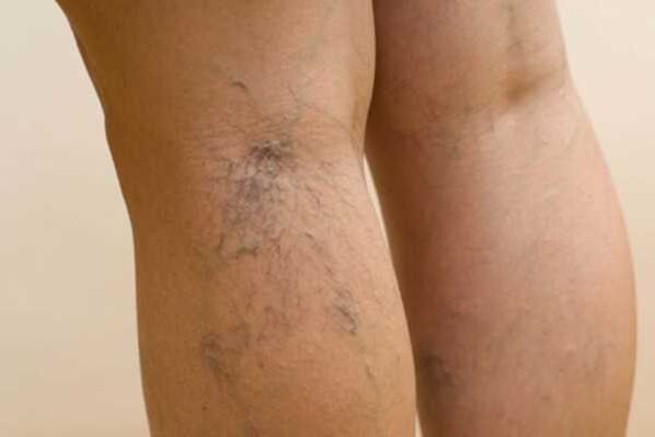 Varicose veins in legs